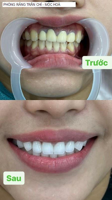Hình ảnh PHÒNG RĂNG TRẦN CHÍ - MỘC HOÁ