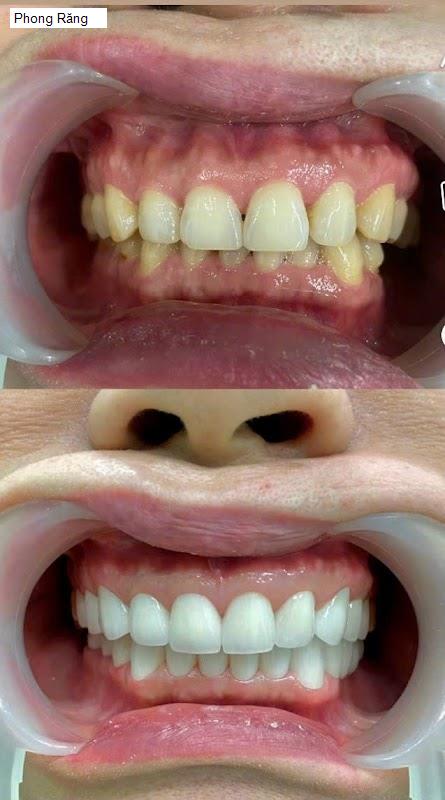 Hình ảnh Phong Răng